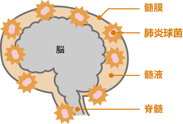 細菌性髄膜炎ってどんな病気